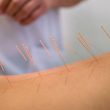 Acupuncture needles on back of a young woman
